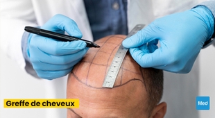 المجلة الطبية La Greffe de Cheveux : Restaurer la Beauté Naturelle et la Confiance en Soi