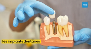 Magazine Les implants dentaires : Une solution durable pour retrouver votre sourire