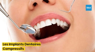 Makaleler Sourire Confiant : Tout ce que Vous Devez Savoir sur les Implants Dentaires Compressifs