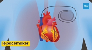 المجلة الطبية Qu'est-ce qu'un Pacemaker ?