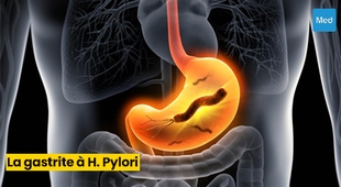 المجلة الطبية Comprendre la Gastrite à Helicobacter pylori : Causes, Symptômes et Traitement