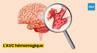 Magazine Comprendre l'AVC Hémorragique : Causes, Symptômes et Prise en Charge