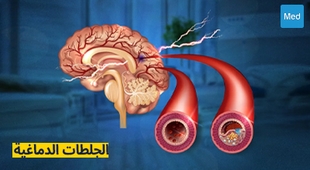 Makaleler الجلطات الدماغية: الأسباب، الأعراض، التشخيص، والعلاج