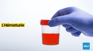 Makaleler Comprendre l'Hématurie : Sang dans l'Urine, Causes et Préoccupations