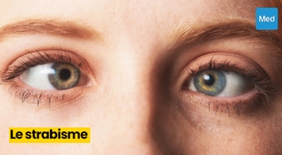 Magazine Le strabisme : un trouble oculaire qui mérite d'être pris au sérieux