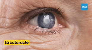 Magazine La cataracte : une maladie oculaire qui peut affecter la qualité de vie