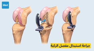 المجلة الطبية جراحة استبدال مفصل الركبة