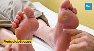 Makaleler Prendre soin de ses pieds quand on est diabétique : Une étape cruciale pour une vie saine