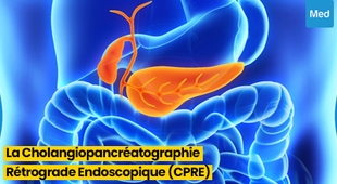 Magazine Tout ce que vous devez savoir sur la Cholangiopancréatographie Rétrograde Endoscopique (CPRE)