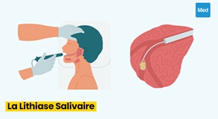 المجلة الطبية Lithiase salivaire : causes, symptômes et traitements