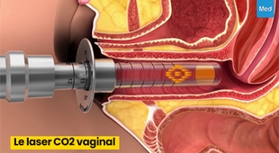 المجلة الطبية Le laser CO2 vaginal : une solution non invasive pour améliorer la santé et le bien-être intimes