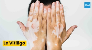 المجلة الطبية Vitiligo : tout ce que vous devez savoir
