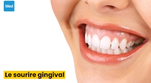 المجلة الطبية Le sourire gingival : définition, causes, diagnostic, traitement et prévention
