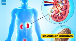 Makaleler Les calculs urinaires : causes, symptômes et traitements