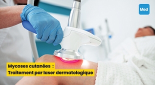 المجلة الطبية Mycoses cutanées : Traitement par laser dermatologique