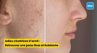 Magazine Adieu cicatrices d'acné : Retrouvez une peau lisse et éclatante