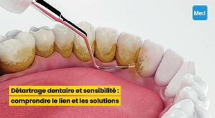 Magazine Détartrage dentaire et sensibilité : comprendre le lien et les solutions