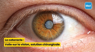 Magazine La cataracte : Voile sur la vision, solution chirurgicale