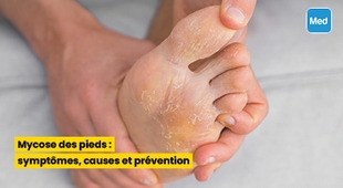 Magazine Mycose des pieds : symptômes, causes et prévention
