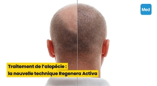 المجلة الطبية Traitement de l'alopécie : la nouvelle technique Regenera Activa