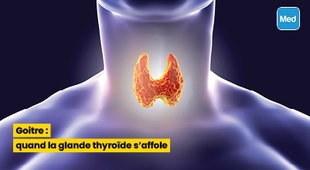 Makaleler Goitre : quand la glande thyroïde s'affole