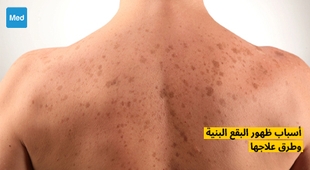 Makaleler أسباب ظهور البقع البنية وطرق علاجها