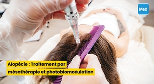 Magazine Alopécie : Traitement par mésothérapie et photobiomodulation