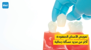 Makaleler تعويض الأسنان المفقودة : أكثر من مجرد مسألة جمالية