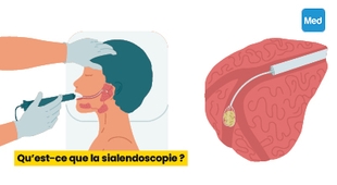 Magazine Qu’est-ce que la sialendoscopie ?