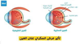 Magazine تأثير مرض السكري على العين