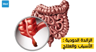 المجلة الطبية الزائدة الدودية : الأسباب والعلاج