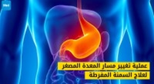 Makaleler عملية تغيير مسار المعدة المصغر لعلاج السمنة المفرطة