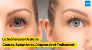 Makaleler La Sécheresse Oculaire : Causes, Symptômes, Diagnostic et Traitement