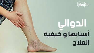الدوالي أسبابها و كيفية العلاج