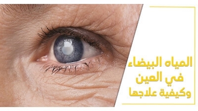 المياه البيضاء في العين وكيفيّة علاجها