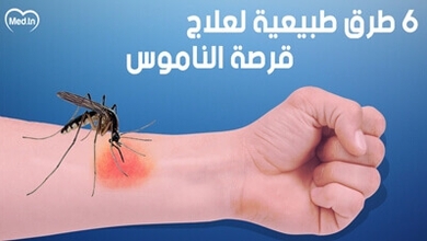 6 طرق طبيعية لعلاج قرصة الناموس