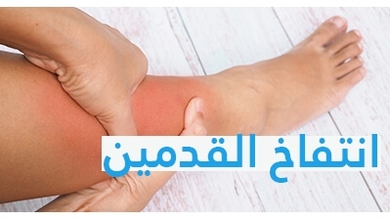 انتفاخ القدمين