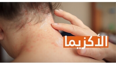 الأكزيما