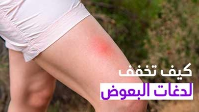 كيف تخفف لدغات البعوض
