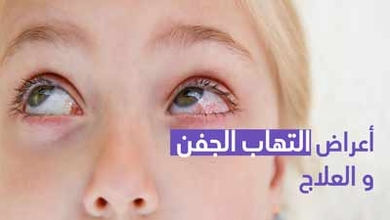 أعراض التهاب الجفن والعلاج