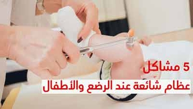 5 مشاكل عظام شائعة عند الرضع والأطفال