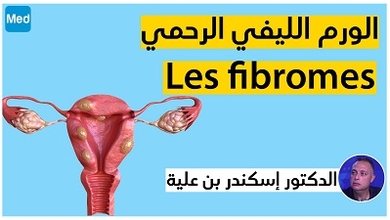 الورم الليفي الرحمي