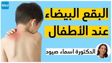 البقع البيضاء عند الأطفال