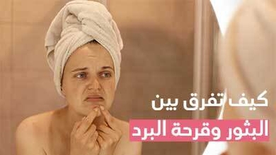 كيف تفرق بين البثور وقرحة البرد