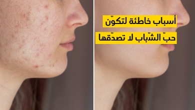 أسباب خاطئة لتكوّن حبّ الشّباب لا تصدّقها