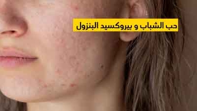 حب الشباب و بيروكسيد البنزول