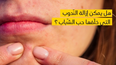 هل يمكن إزالة النّدوب التي خلّفها حب الشّباب ؟