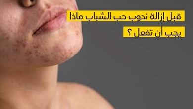 قبل إزالة ندوب حب الشباب ماذا يجب أن تفعل ؟