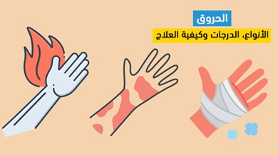 الحروق: الأنواع، الدرجات وكيفية العلاج
