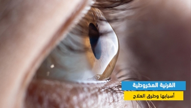 القرنية المخروطية: أسبابها وطرق العلاج